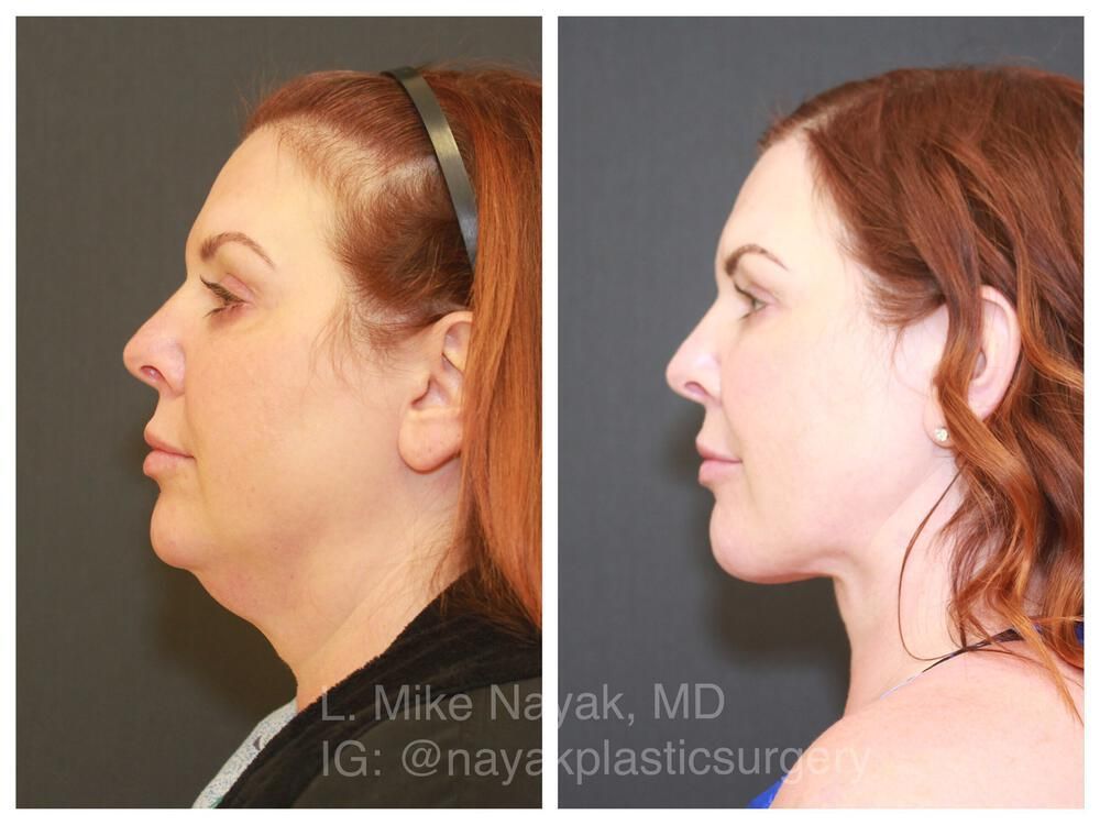Deep Necklift Before & After