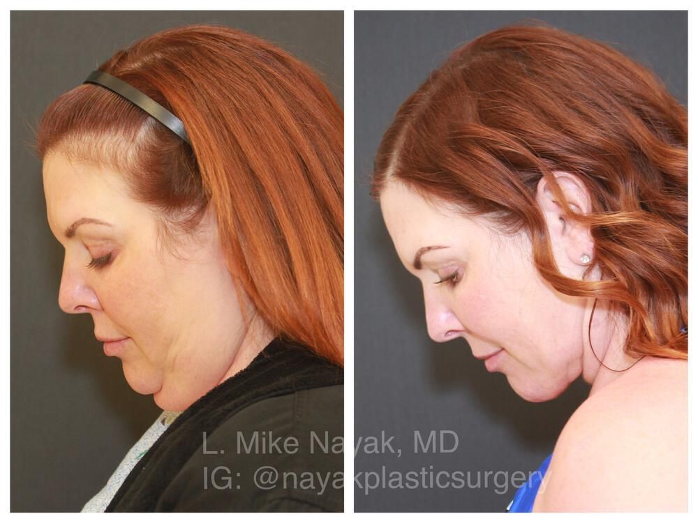 Deep Necklift Before & After