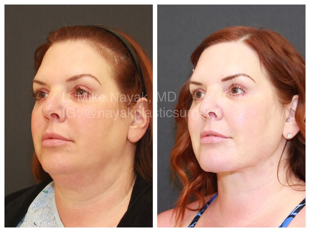 Deep Necklift Before & After