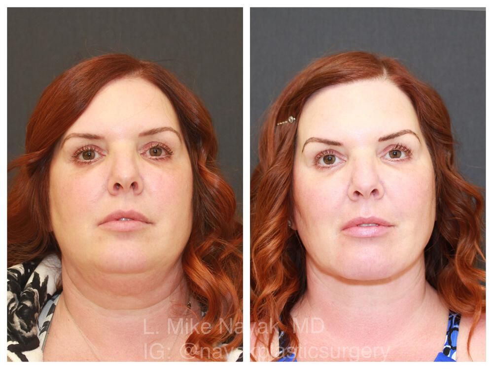 Deep Necklift Before & After