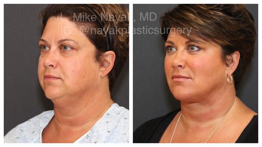 Deep Necklift Before & After