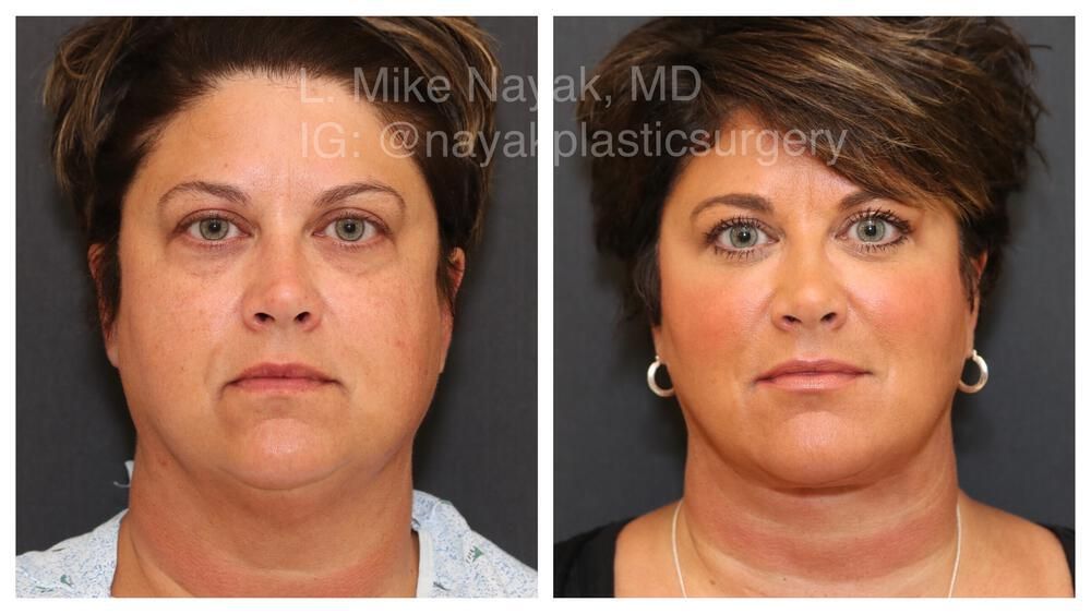 Deep Necklift Before & After
