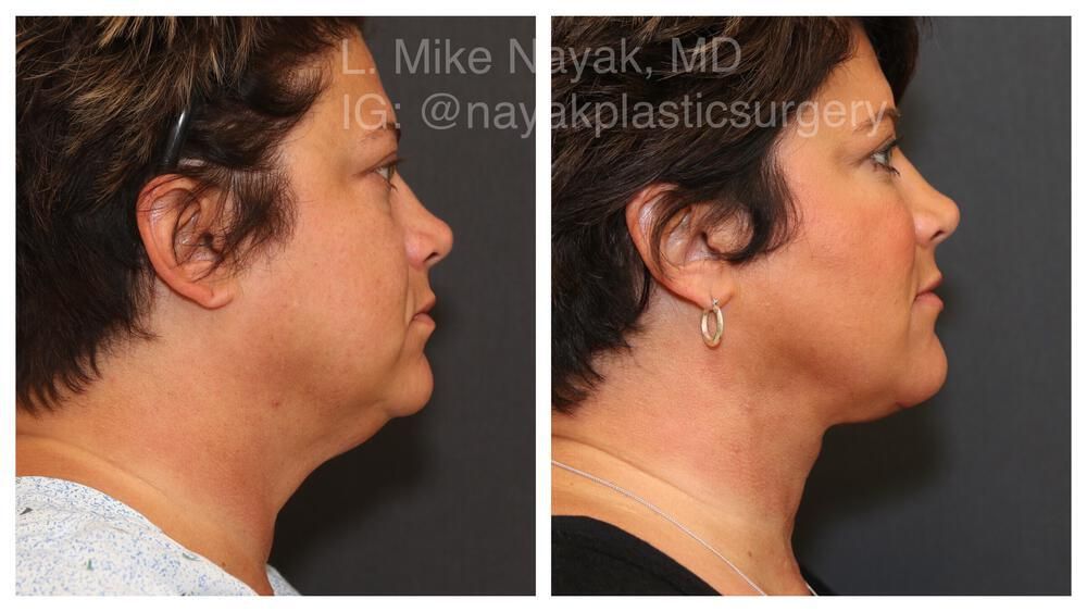 Deep Necklift Before & After
