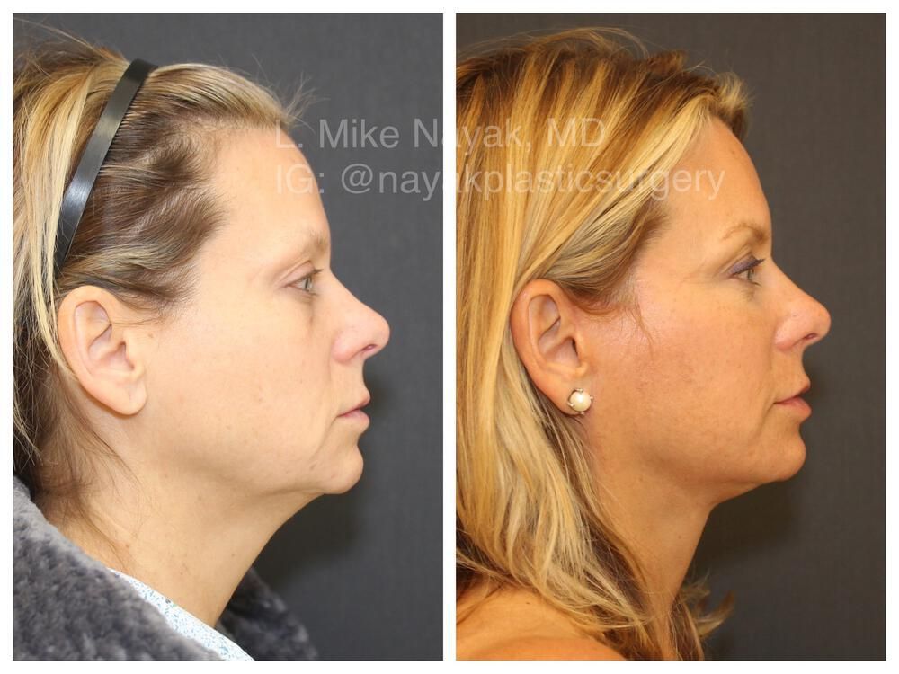 Deep Necklift Before & After