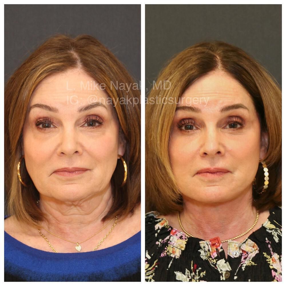 Deep Necklift Before & After