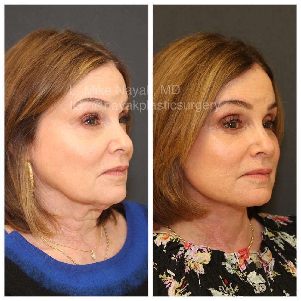 Deep Necklift Before & After