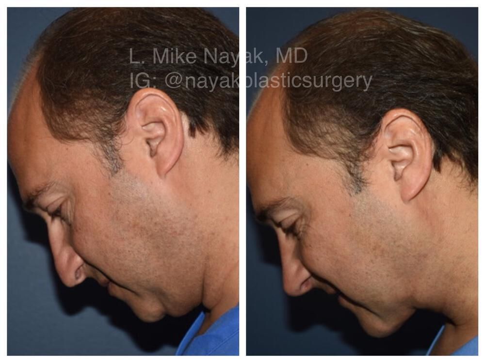 Deep Necklift Before & After
