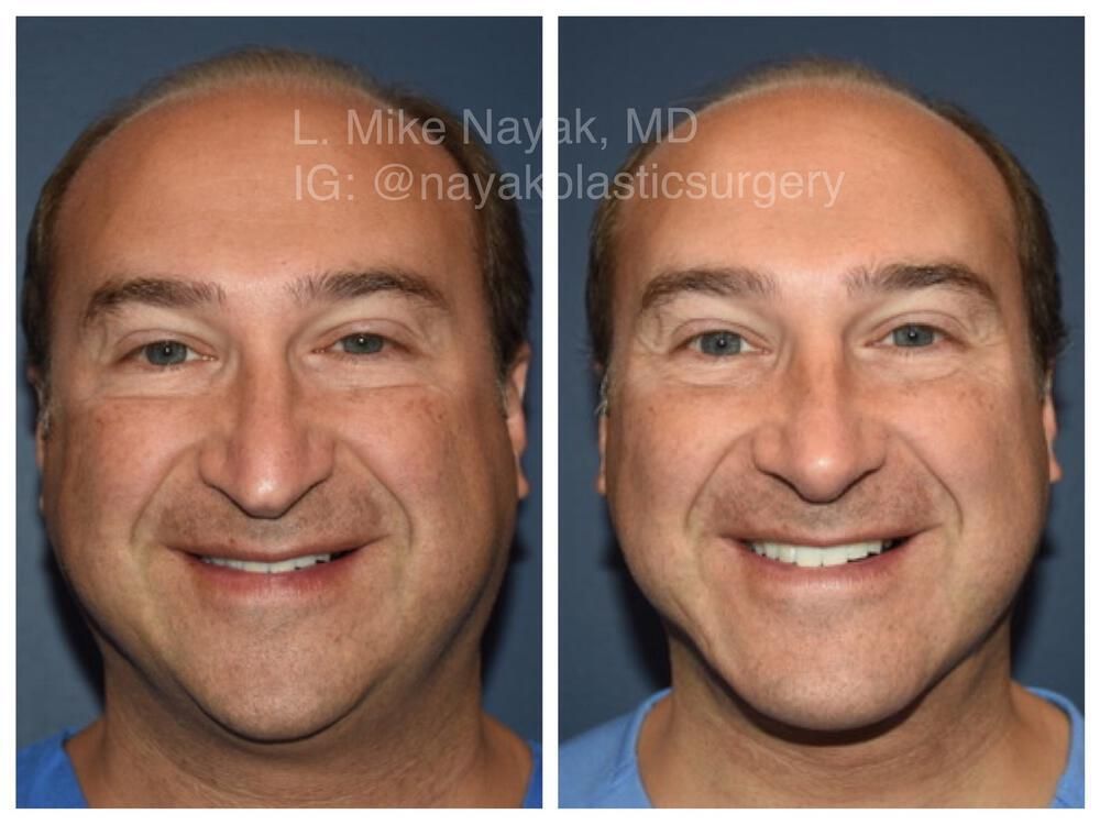 Deep Necklift Before & After