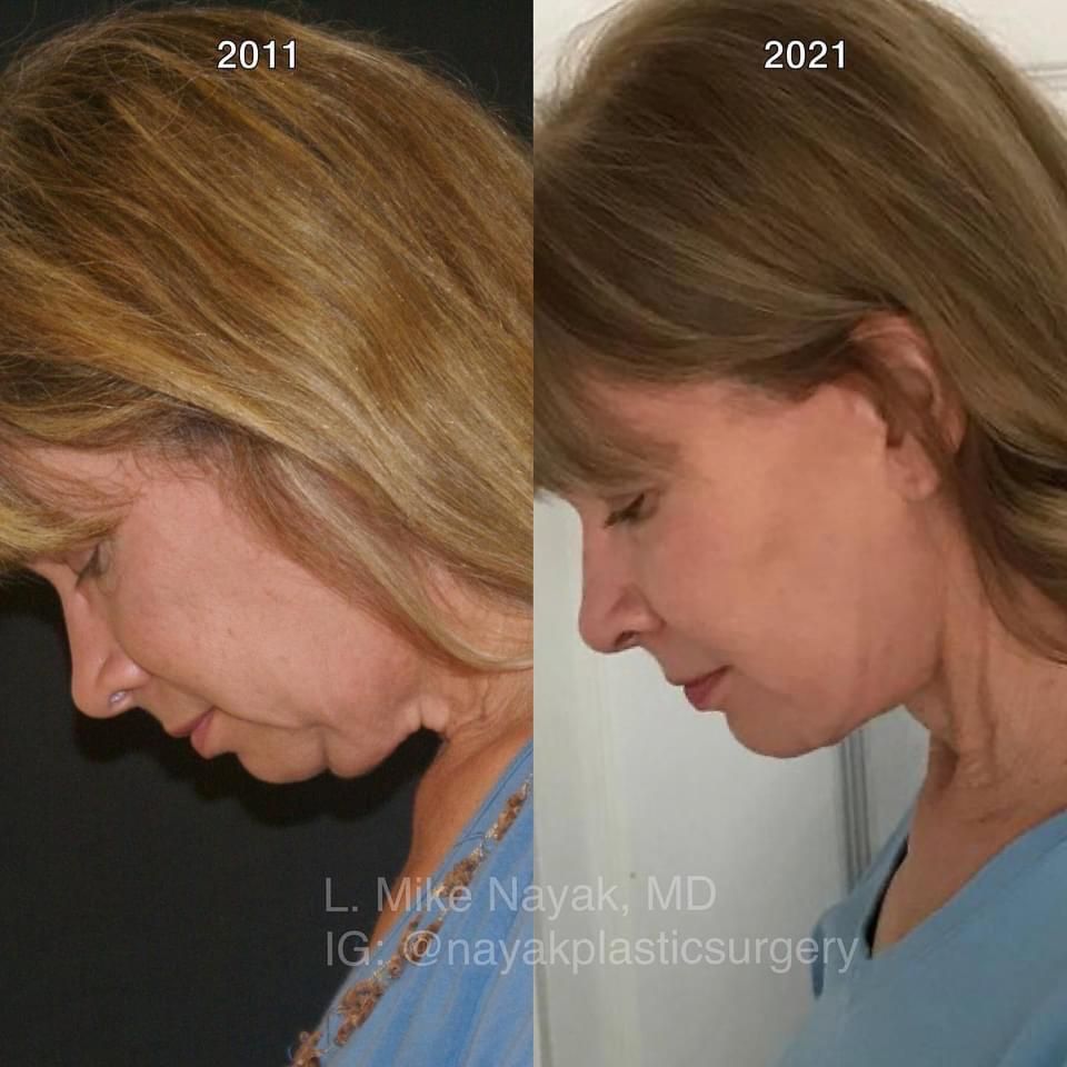 Deep Necklift Before & After
