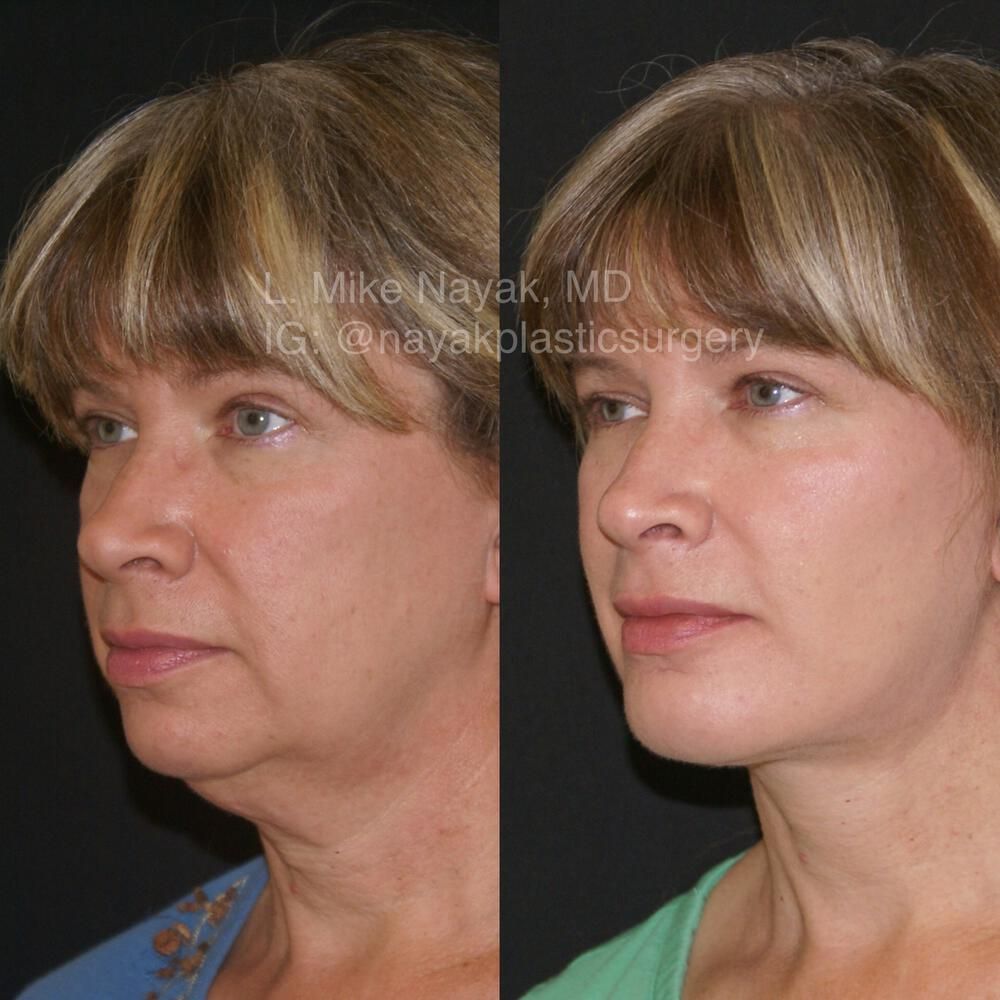 Deep Necklift Before & After