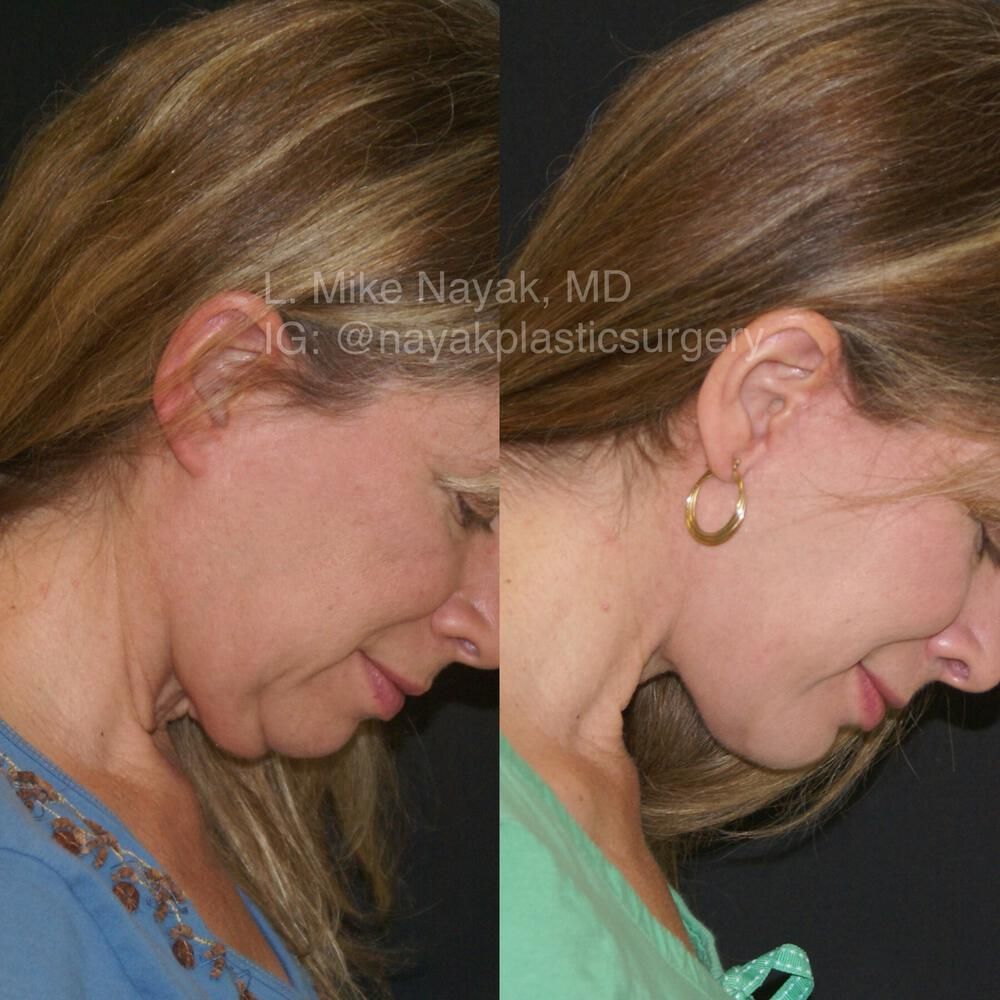 Deep Necklift Before & After