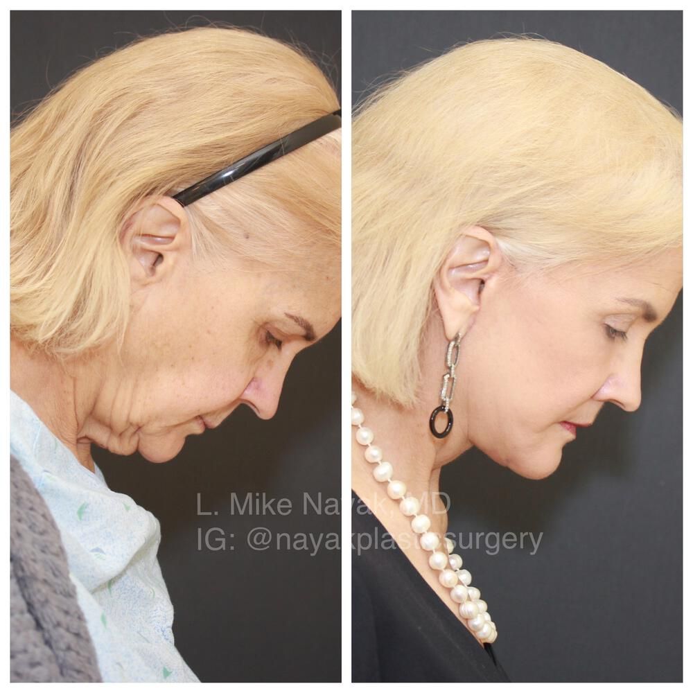Deep Necklift Before & After