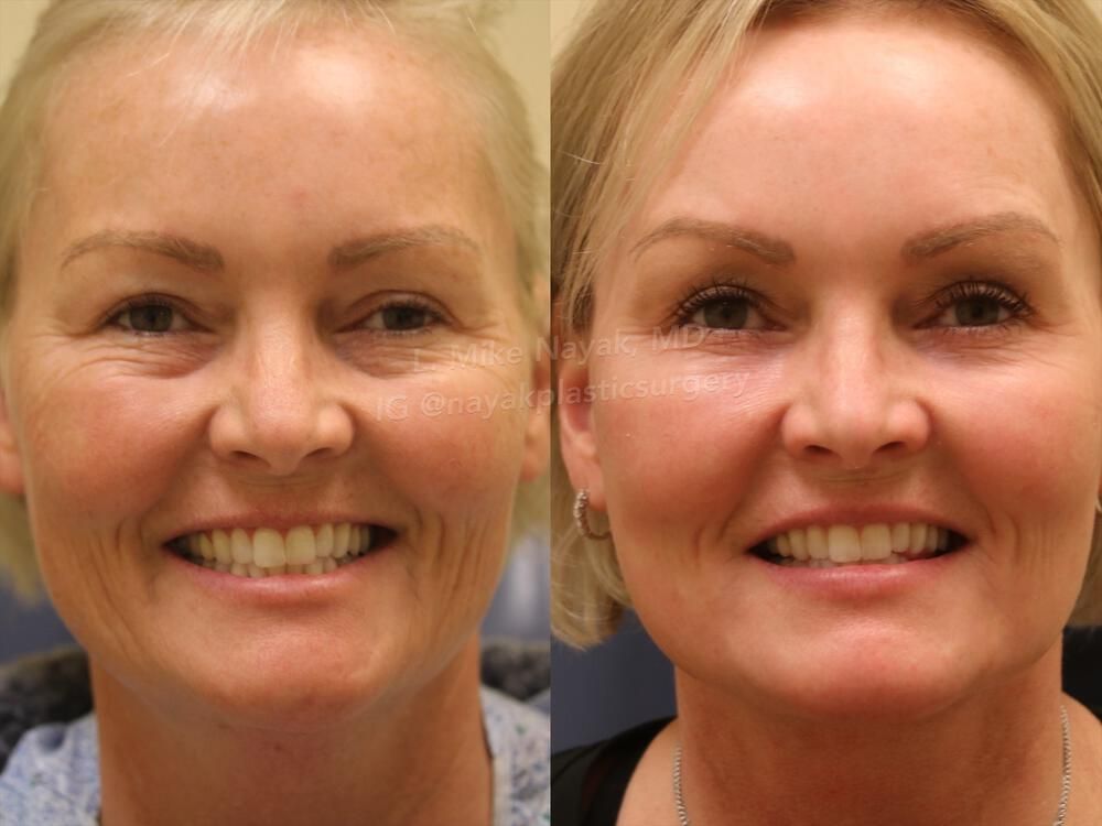 Deep Necklift Before & After