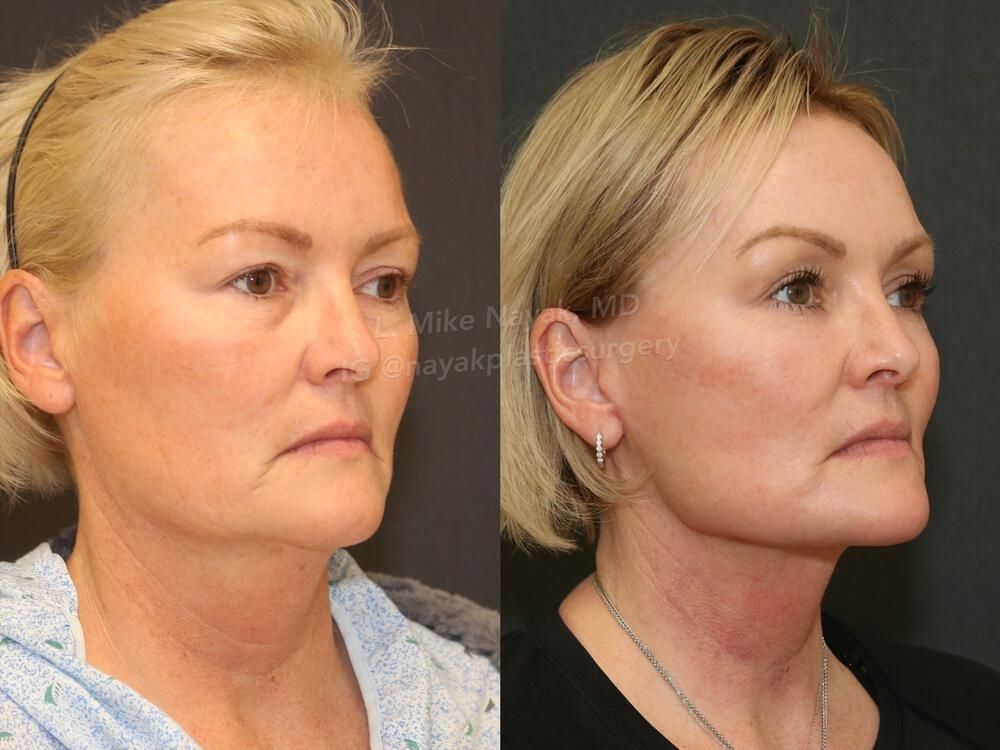 Deep Necklift Before & After