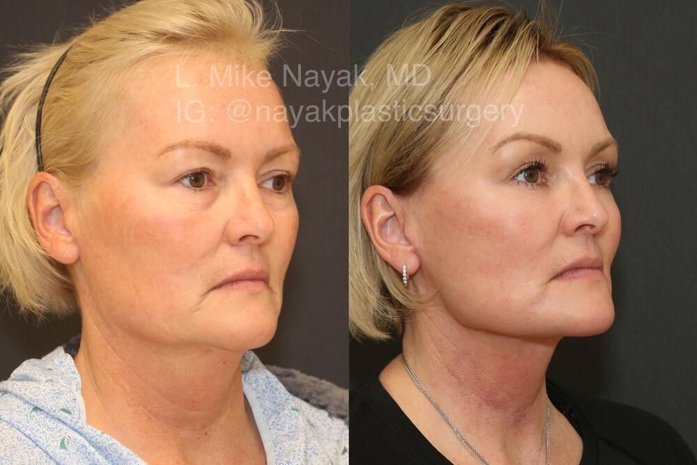 Deep Necklift Before & After