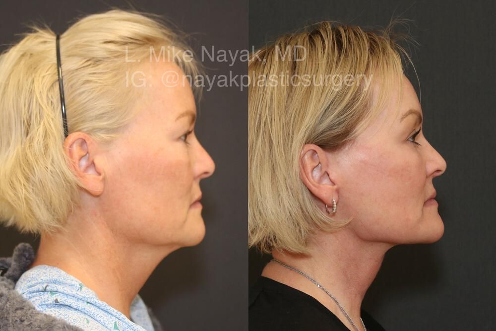 Deep Necklift Before & After