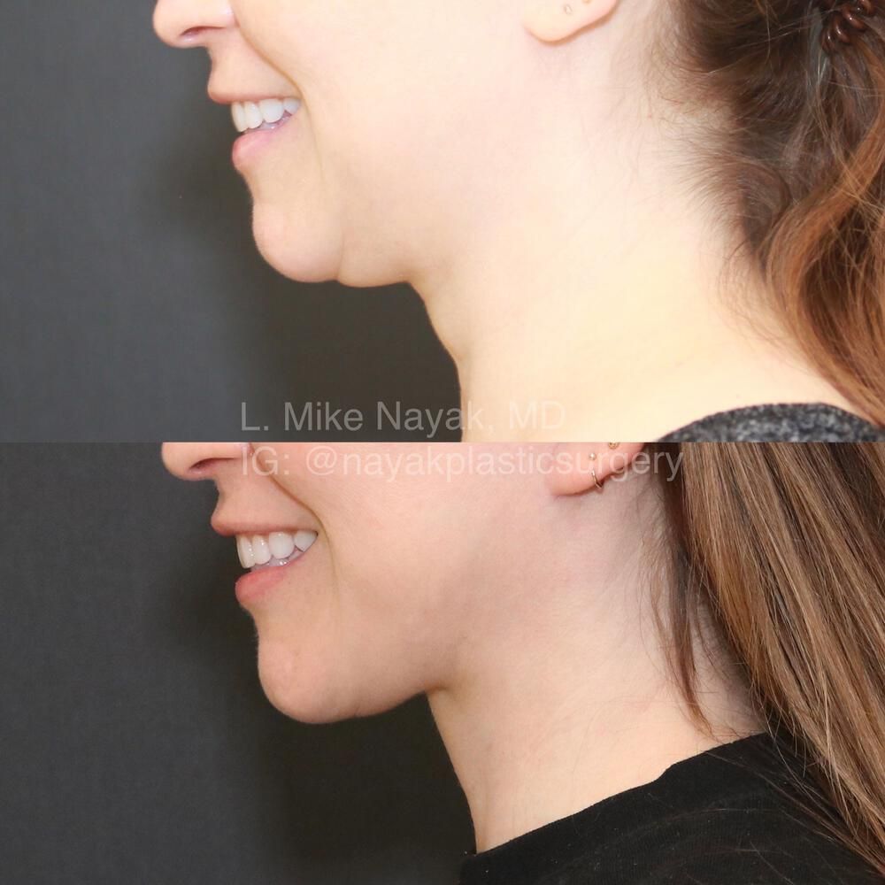 Deep Necklift Before & After