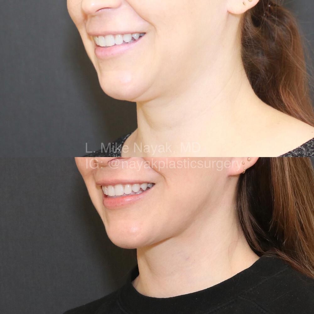 Deep Necklift Before & After