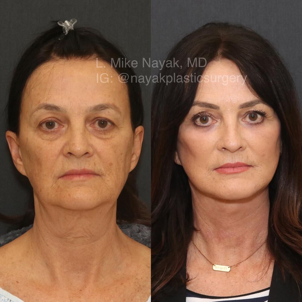 Deep Necklift Before & After