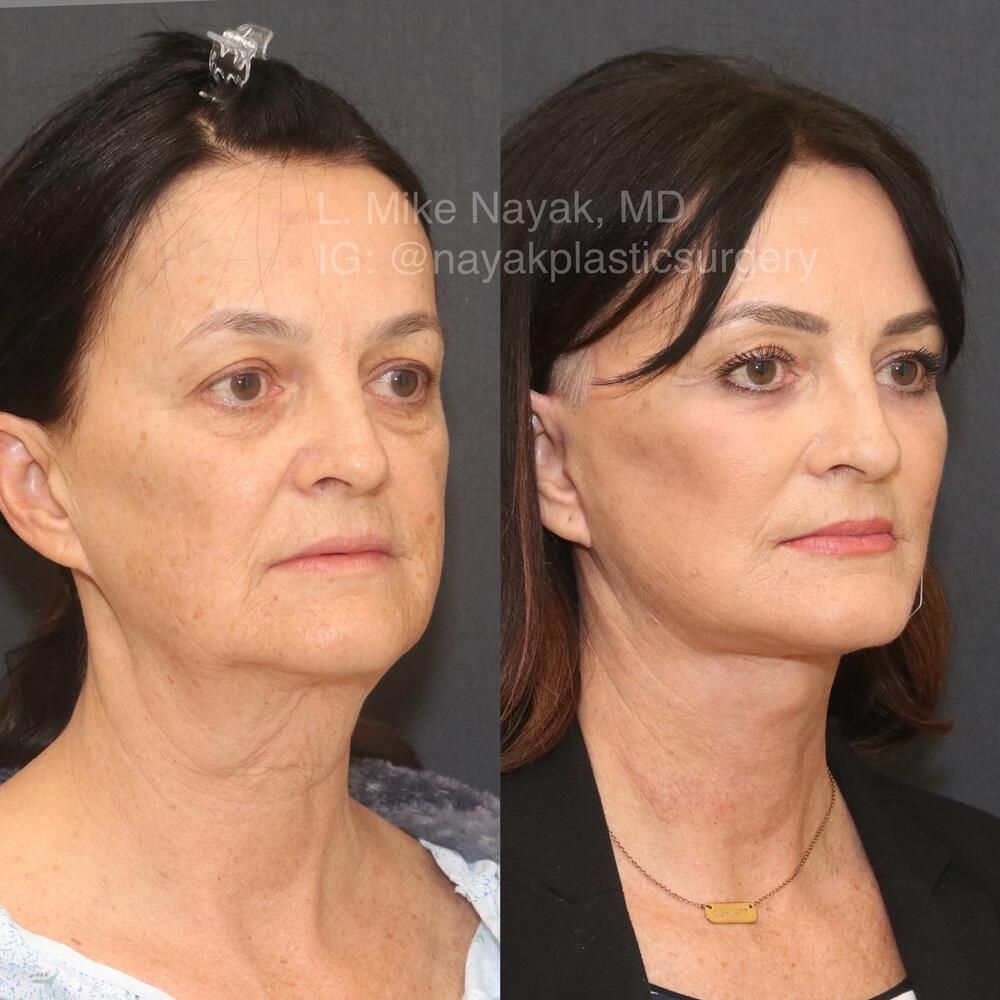 Deep Necklift Before & After