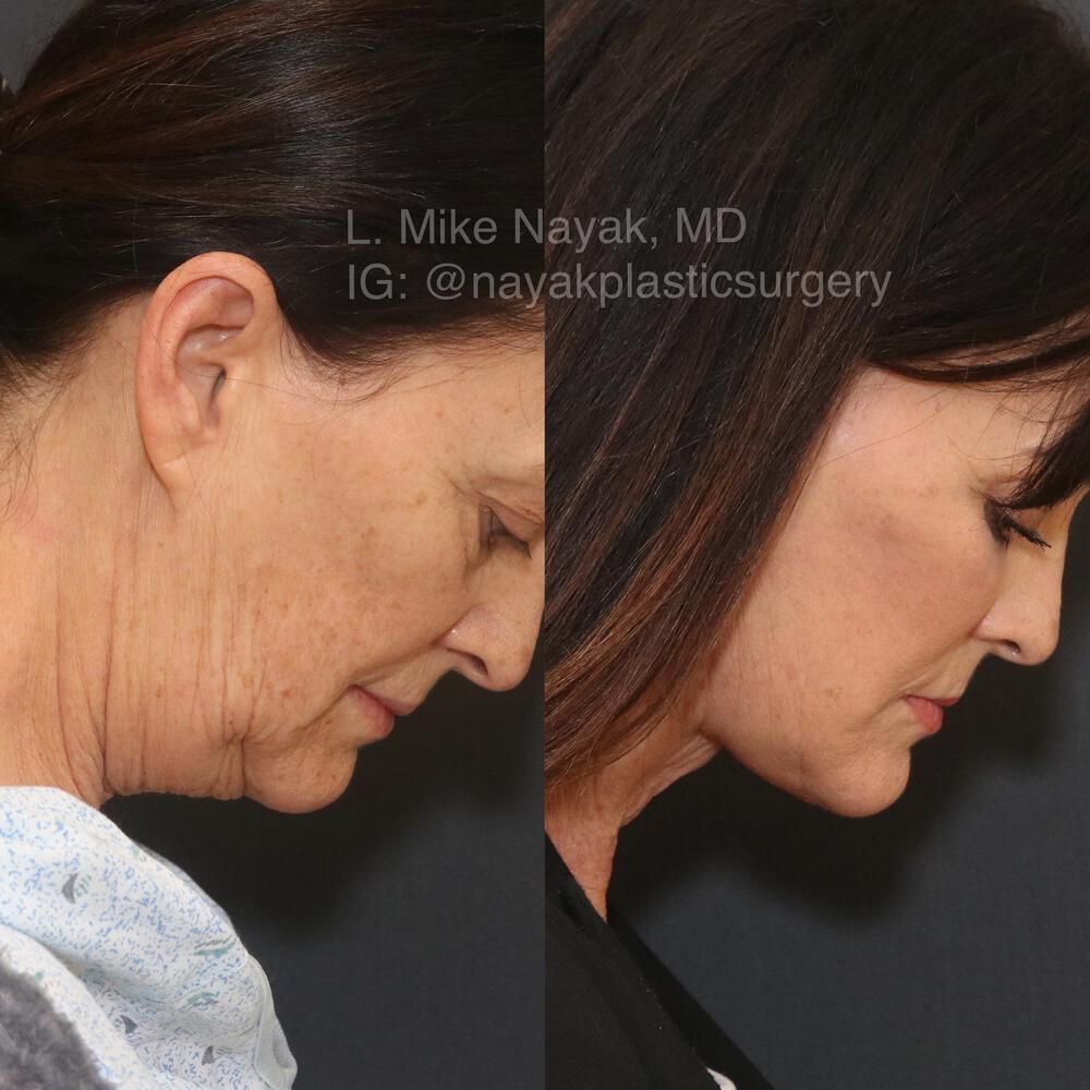 Deep Necklift Before & After