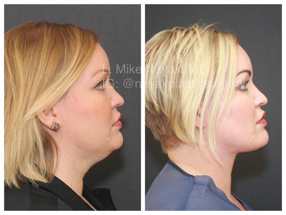 Deep Necklift Before & After