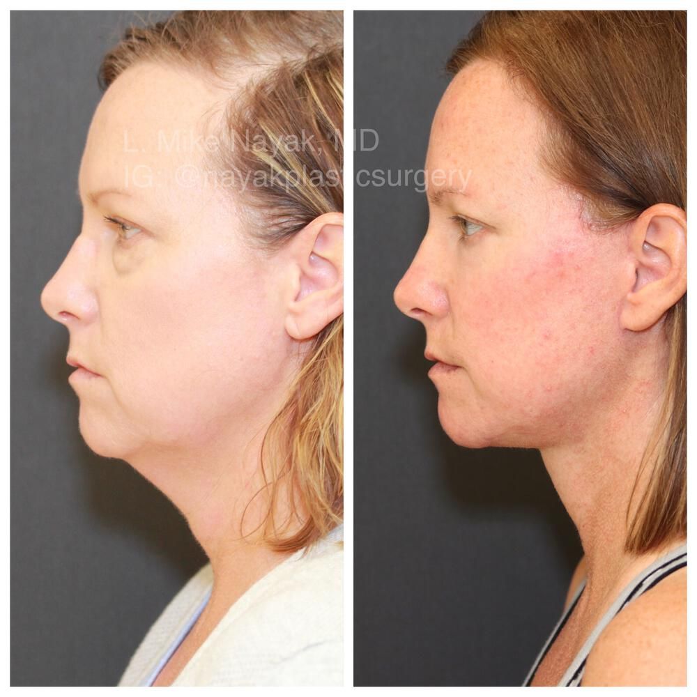 Deep Necklift Before & After