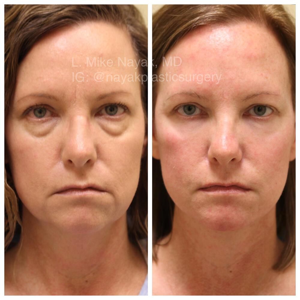 Deep Necklift Before & After