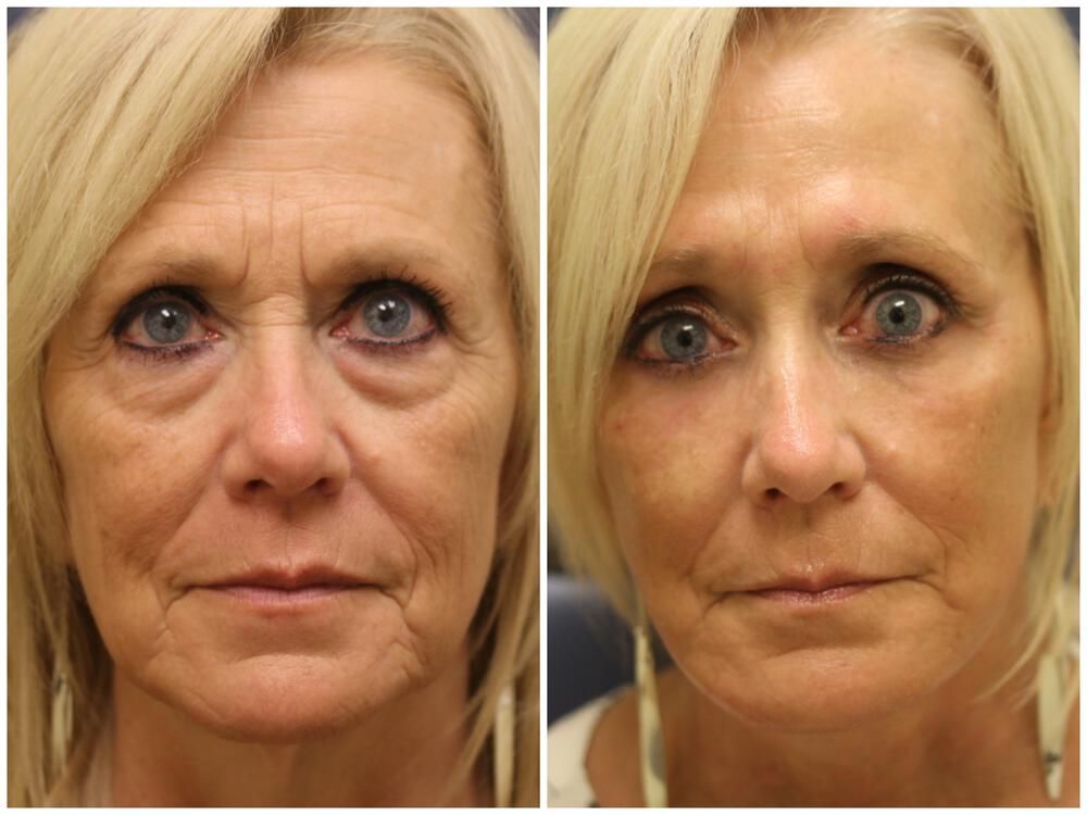 Deep Necklift Before & After