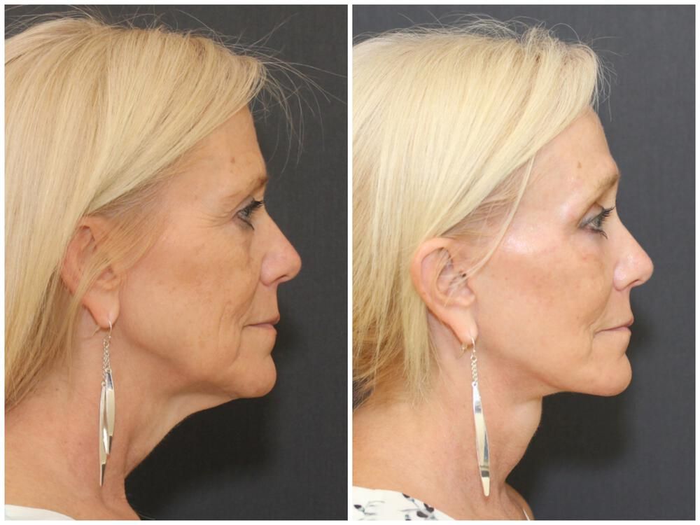 Deep Necklift Before & After