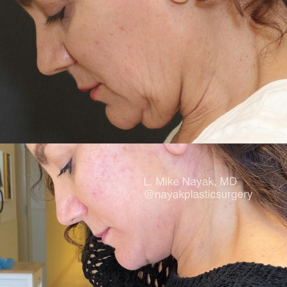 Deep Necklift Before & After
