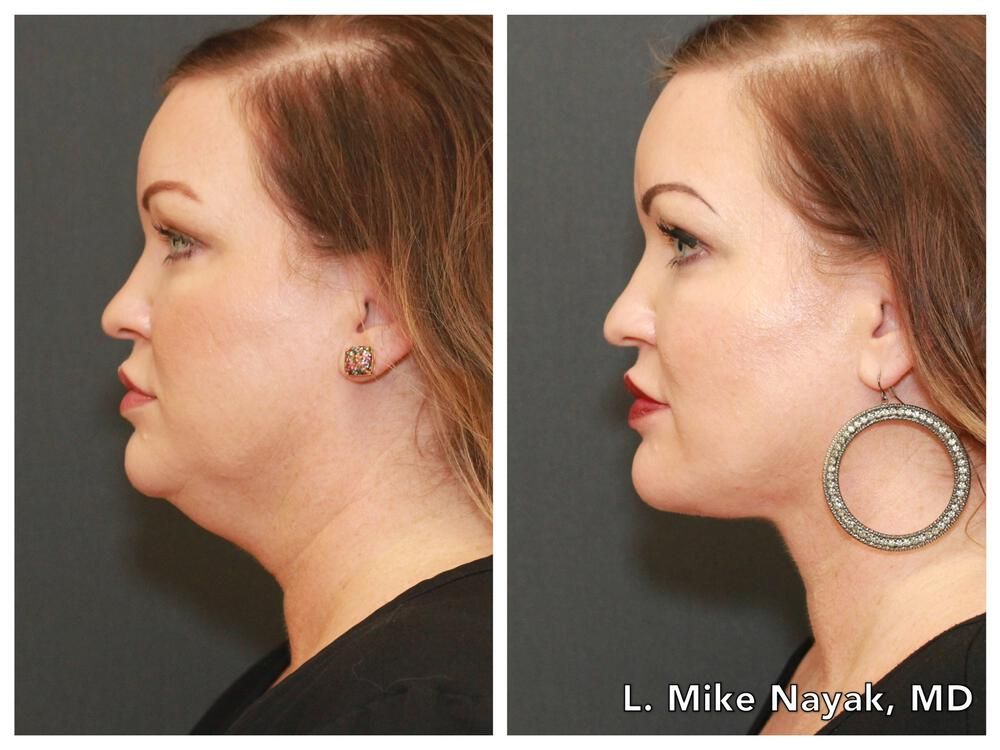 Deep Necklift Before & After