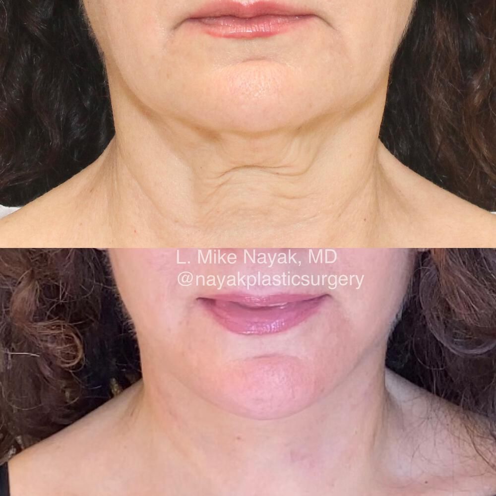Deep Necklift Before & After