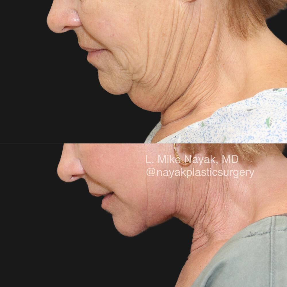 Deep Necklift Before & After