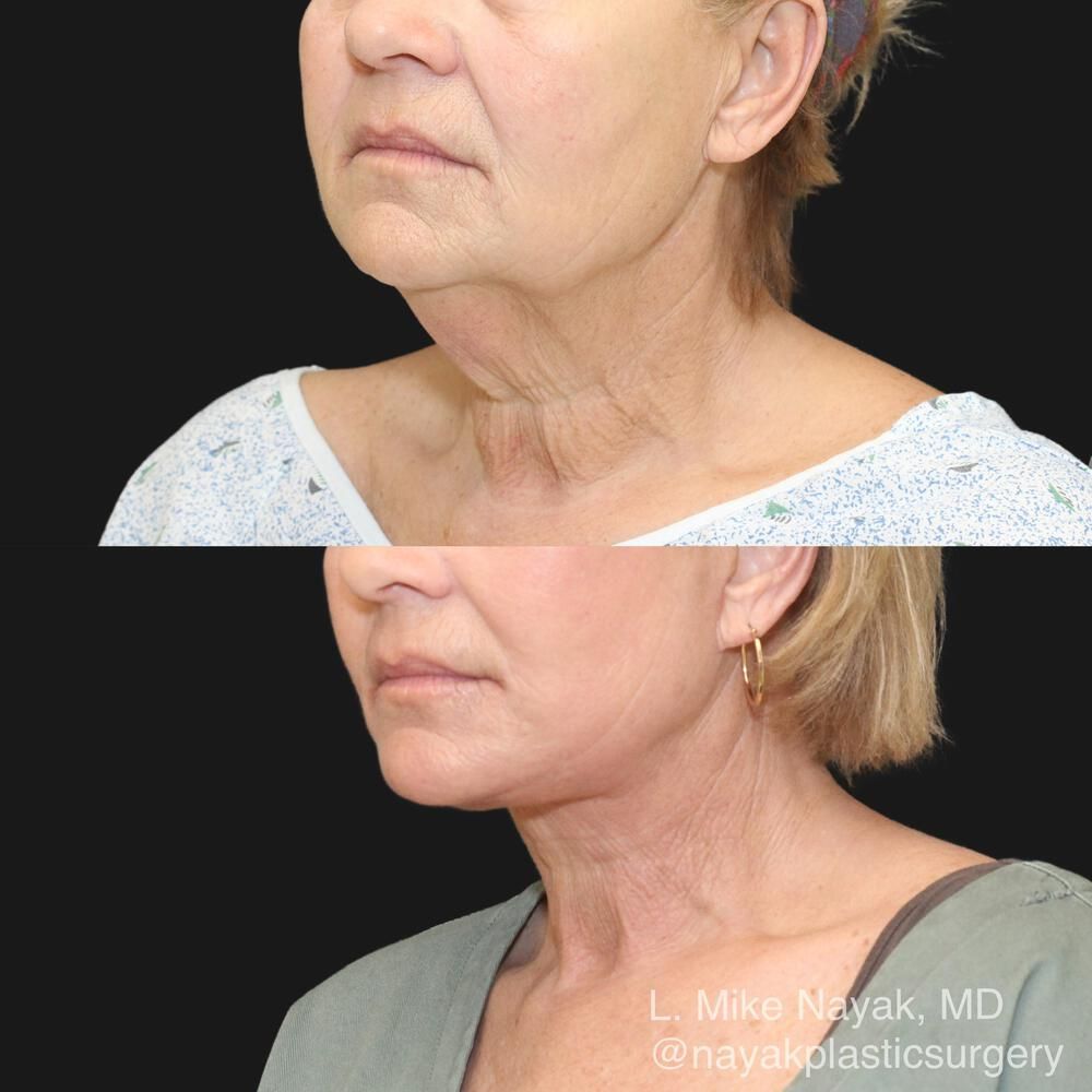 Deep Necklift Before & After