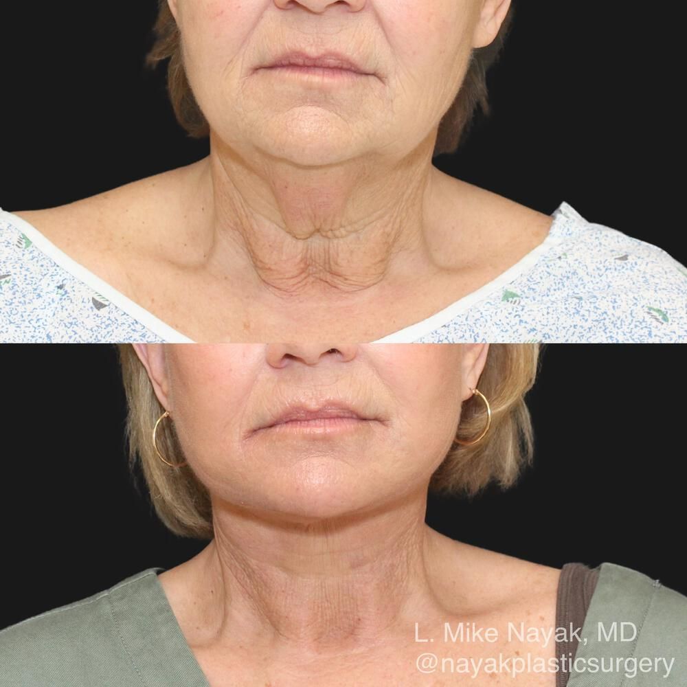 Deep Necklift Before & After