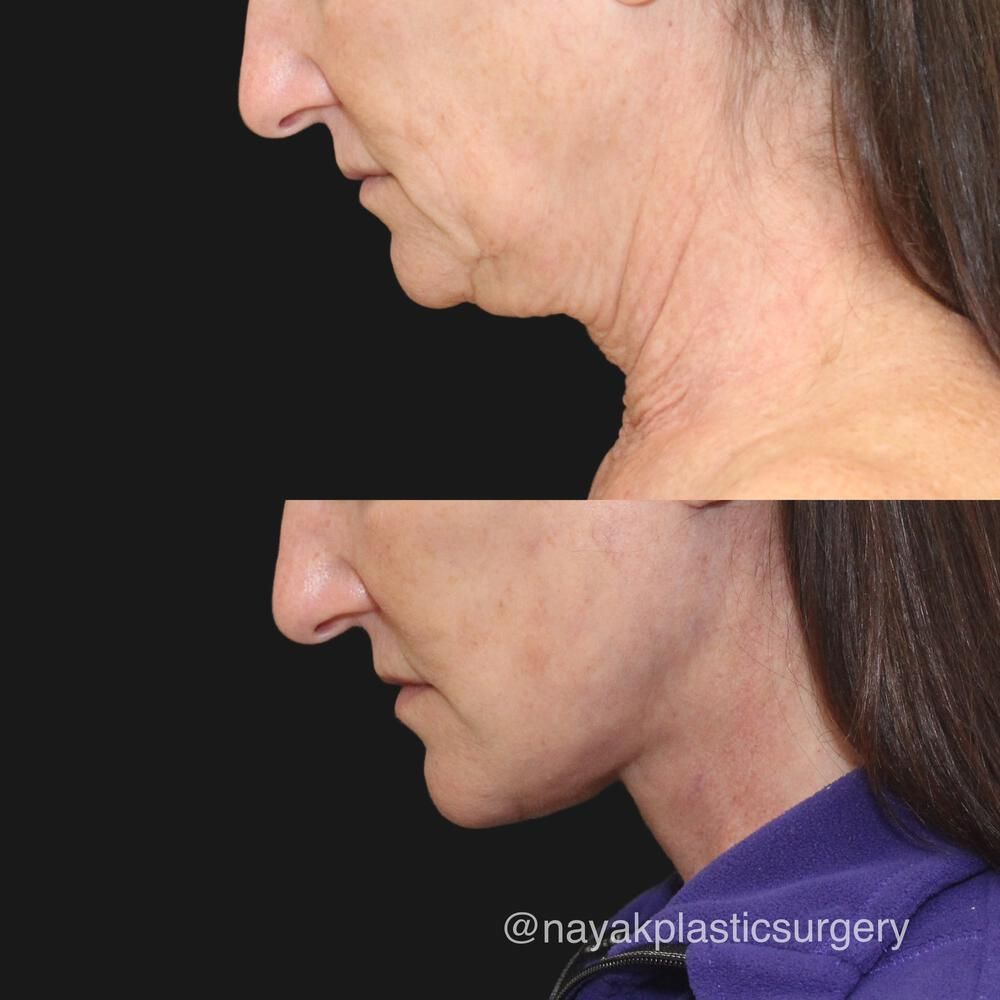 Deep Necklift Before & After