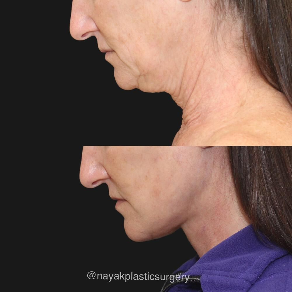 Deep Necklift Before & After