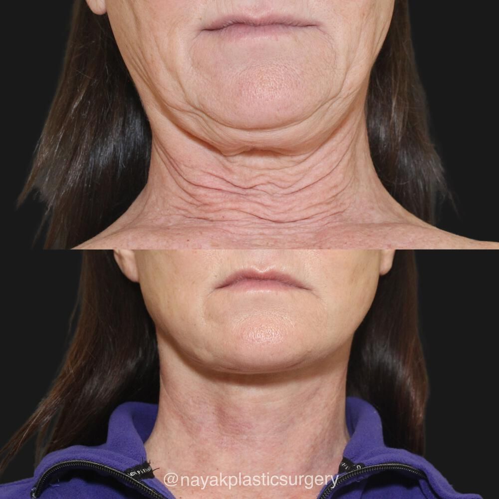 Deep Necklift Before & After