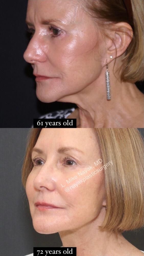 Deep Necklift Before & After