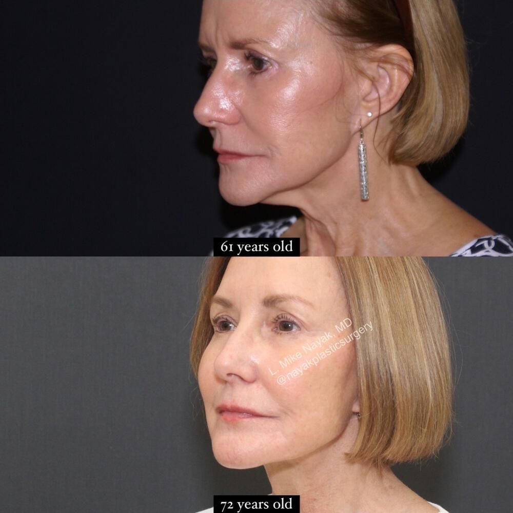 Deep Necklift Before & After