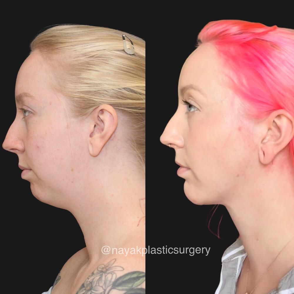 Deep Necklift Before & After