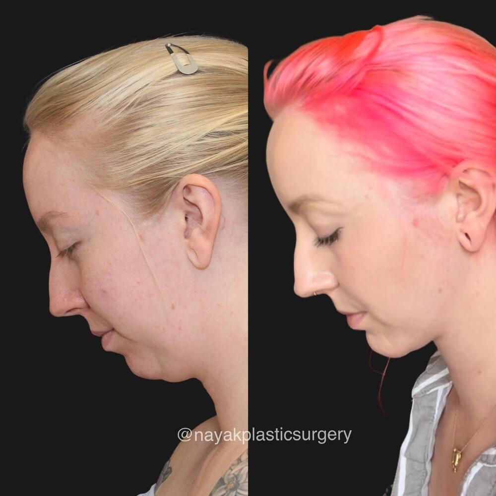 Deep Necklift Before & After