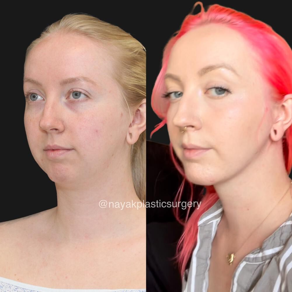 Deep Necklift Before & After