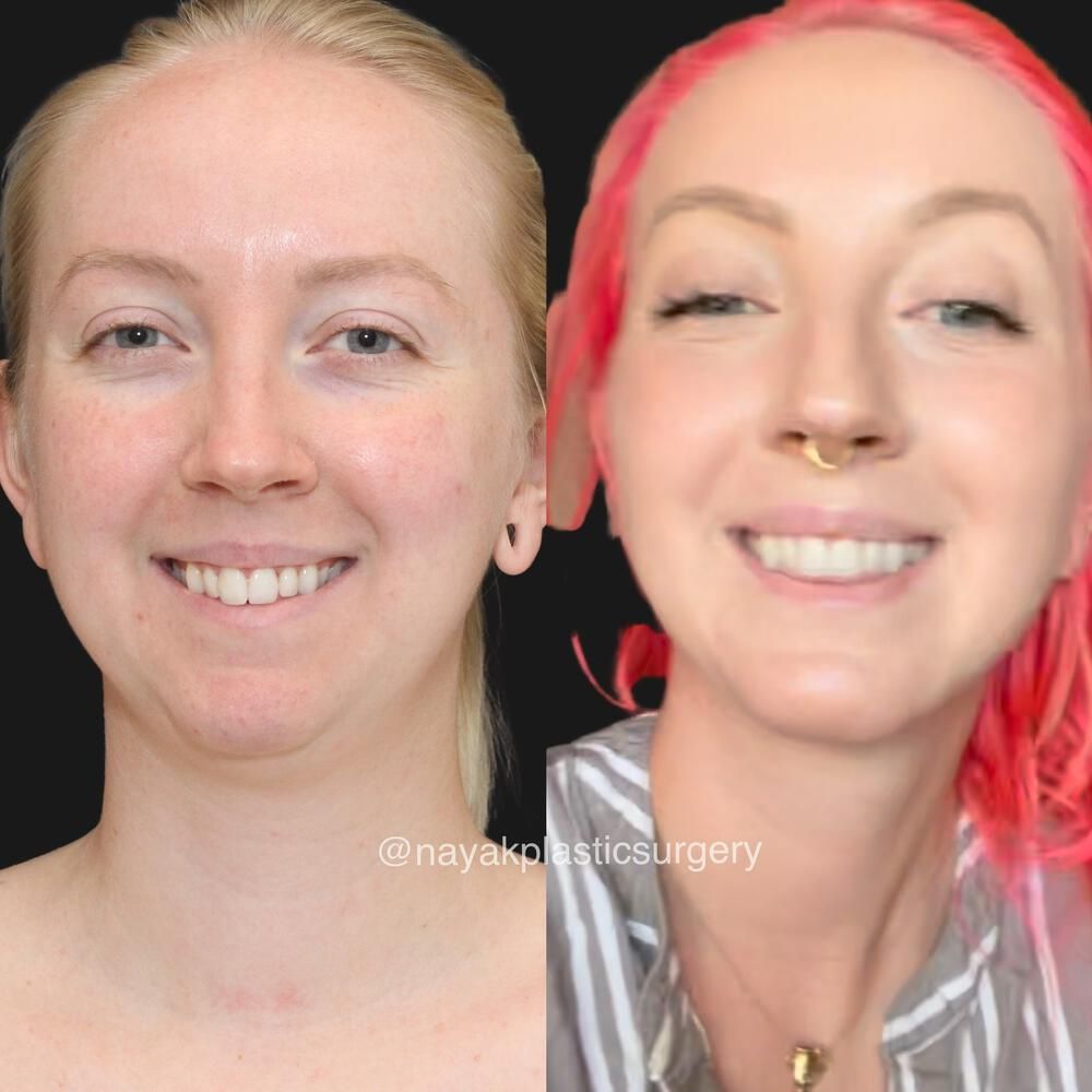 Deep Necklift Before & After