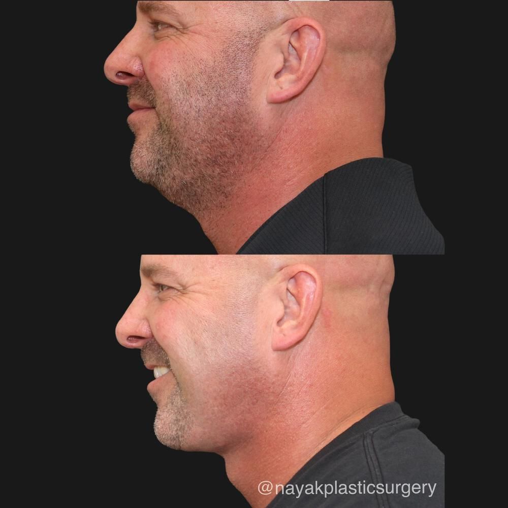 Deep Necklift Before & After