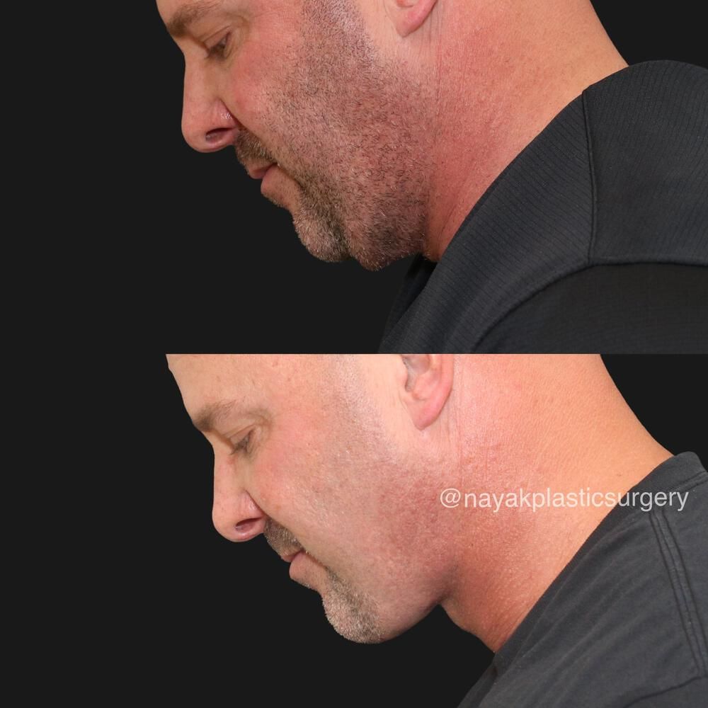 Deep Necklift Before & After