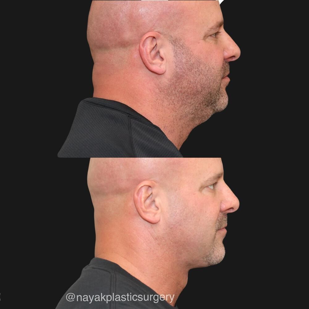 Deep Necklift Before & After