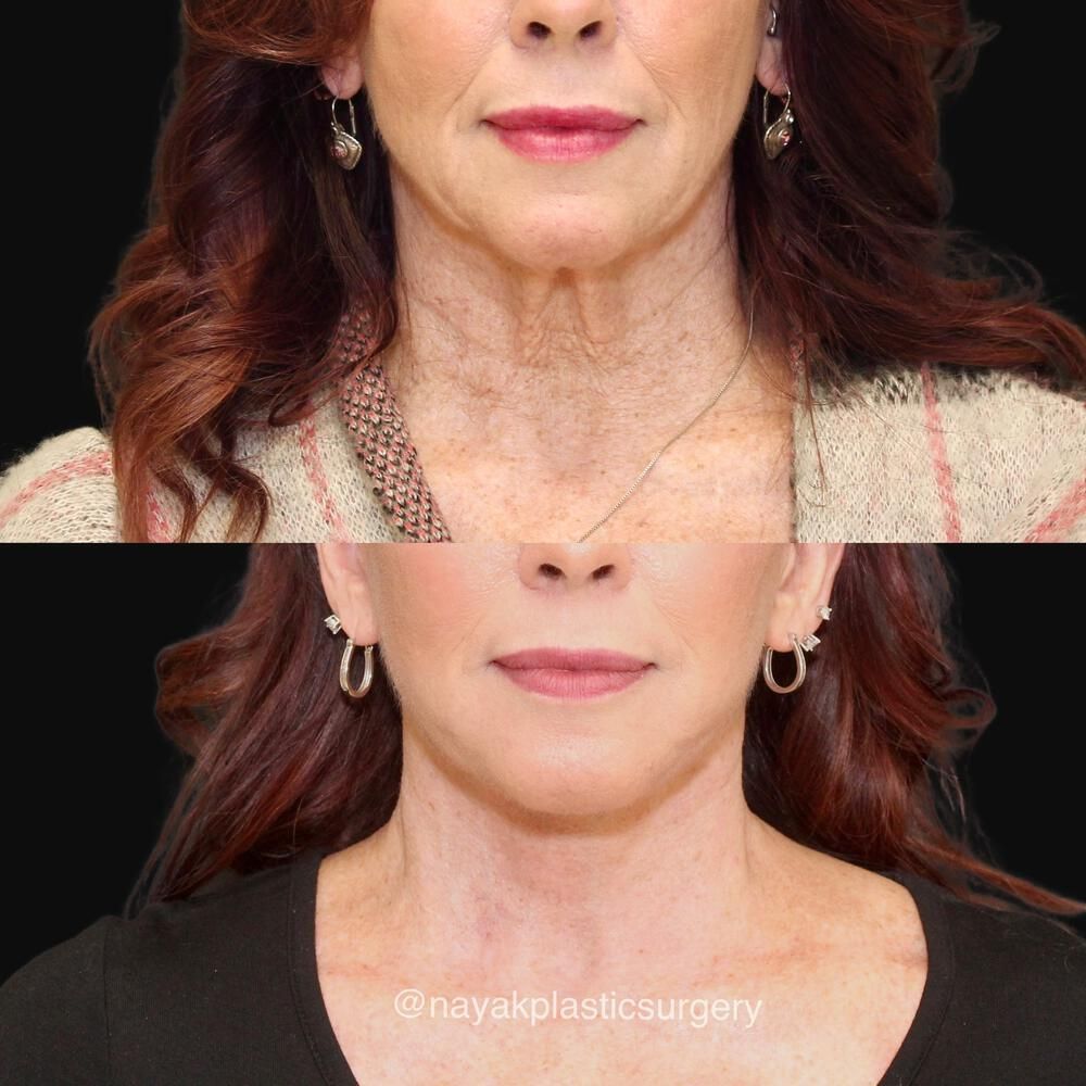 Deep Necklift Before & After