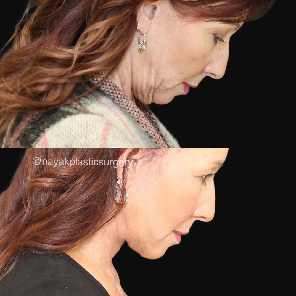 Deep Necklift Before & After